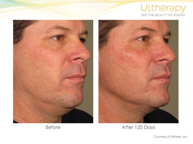 Ultherapy Neck and Eye Lift