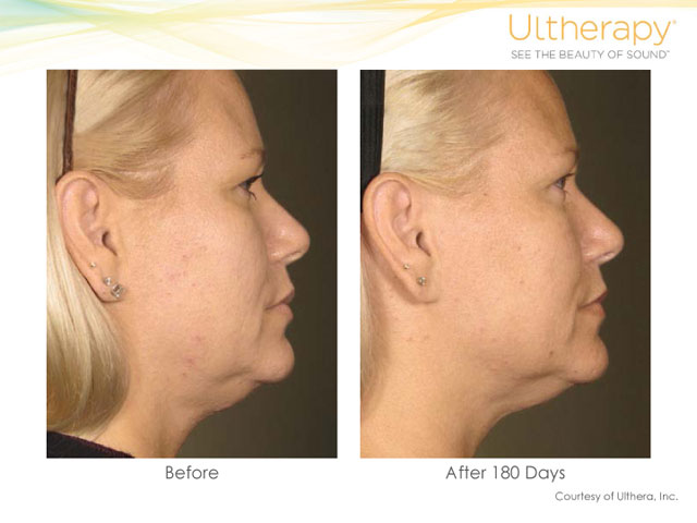 Ultherapy Neck Lift